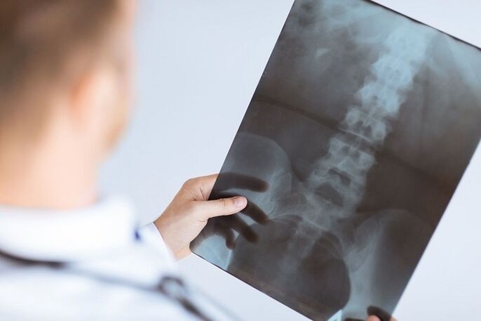 Diagnosis of lumbar bone osteochondrosis