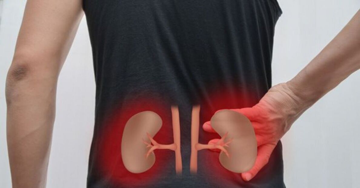 Kidney inflammation may cause low back pain