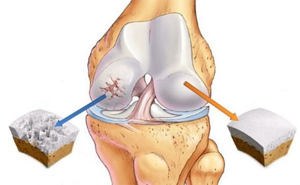 Osteoarthritis of the knee (left) and normal cartilage (right)