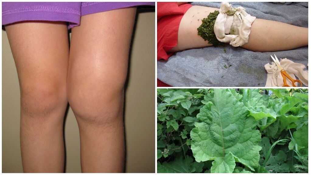 Pressing the knees with burdock - a folk method for treating knee joint disease