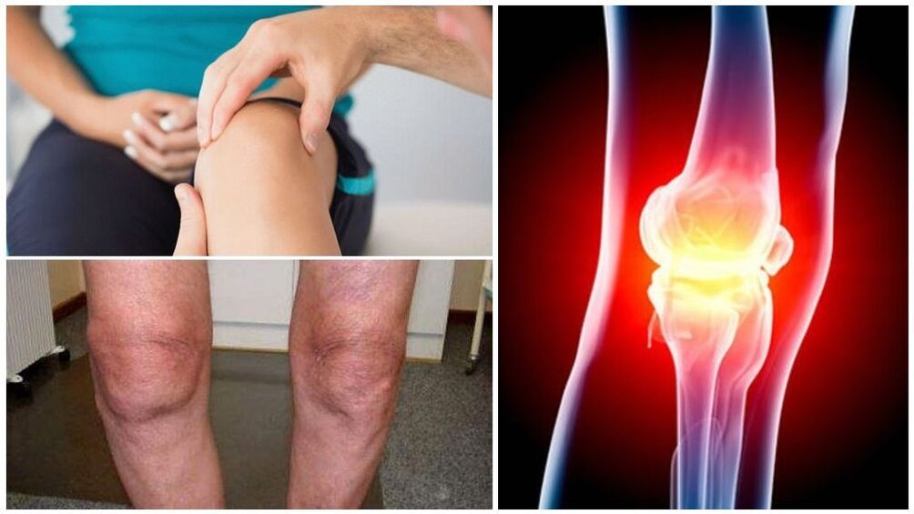 symptoms of knee arthritis