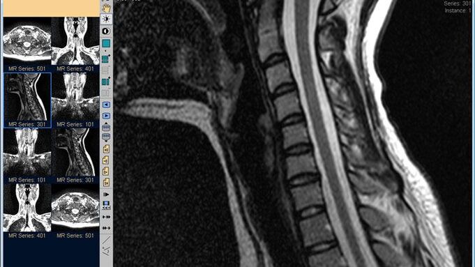 Cervical Spine MRI Is the Best Way to Diagnose Neck Pain