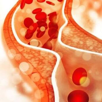 Cholesterol deposits on the inner walls of blood vessels can cause pain on one side of the neck