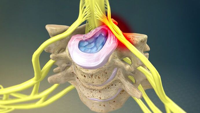 Herniated disc causes neck pain
